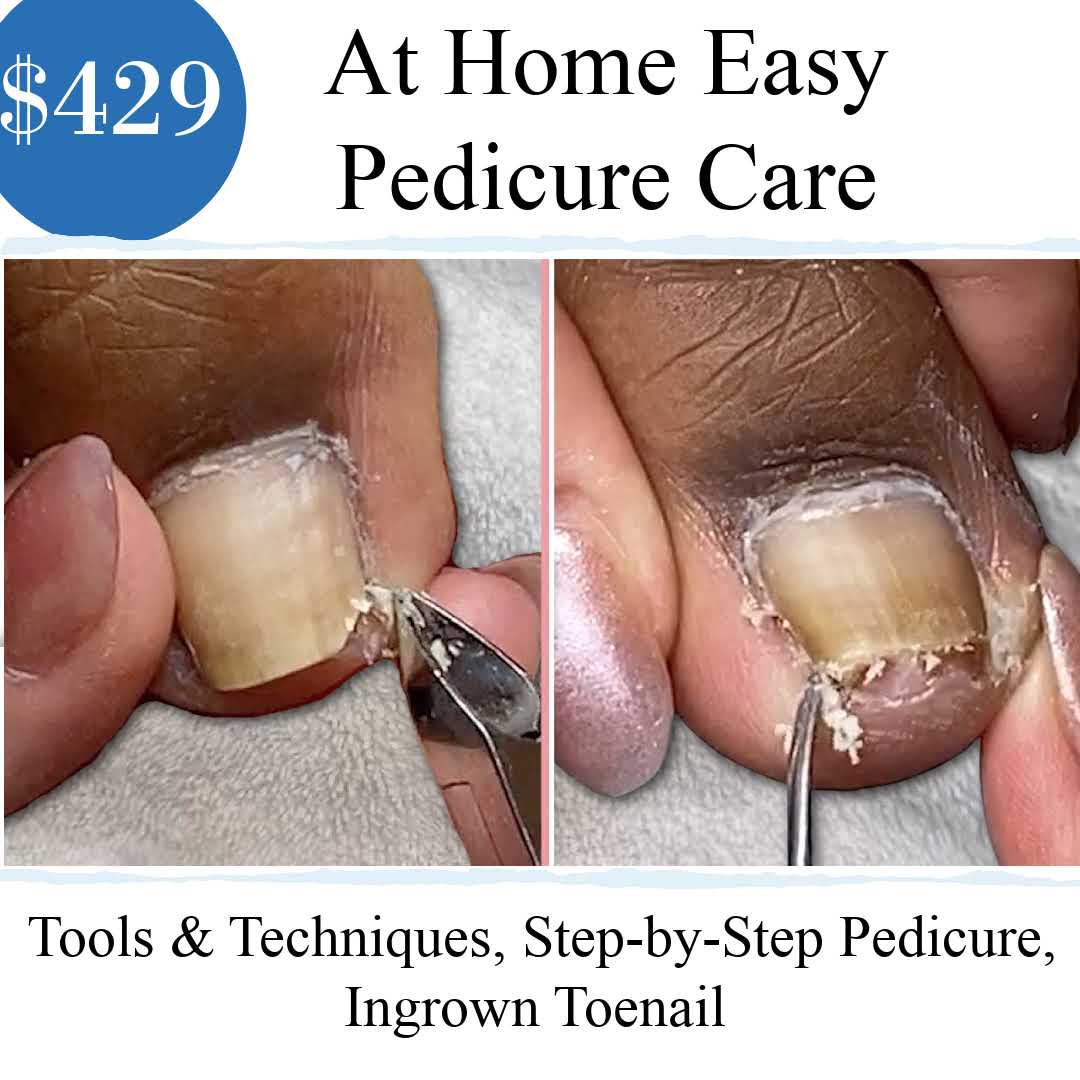 Ingrown Toenail Cleaning and Cure - Pedicure Training Courses