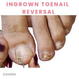 Ingrown Toenail Reversal at Home