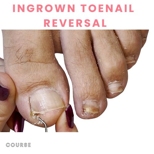 ingrown toenail fix at home