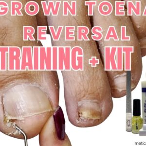Ingrown Toenail Reversal Training Plus Kit